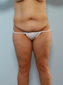 Body Lift