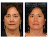 Eye Bag Surgery