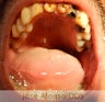 Total Restorations Crowns over Post Core