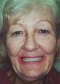 Facelift Dentures & Dental Implants