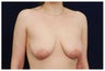 Breast Lift