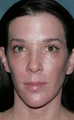 Female Patient Fraxel Repair for Face