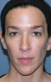 Female Patient Fraxel Repair for Face