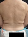 Coolsculpting