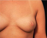 Nipple Surgery