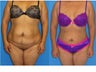 33 Year Old Female underwent Liposuction of full midsection, back, and flanks + BBL (Fat transfer to buttocks)