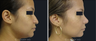 Nose Surgery