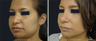 Nose Surgery