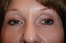Restylane