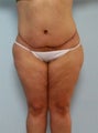 Body Lift