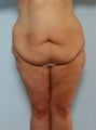 Body Lift
