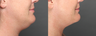 SmartLipo Liposuction of Neck