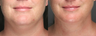 SmartLipo Liposuction of Neck