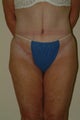 Body lift