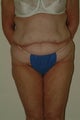 Body lift