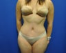 Hourglass Tummy Tuck by Dr. Wilberto Cortes