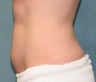 Coolsculpting