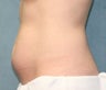 Coolsculpting