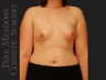 Bilateral mastectomy with tissue expanders; silicone implant exchange; fat grafting; nipple reconstruction; areola pigmentation