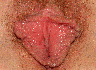 Labiaplasty