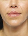 Lip Augmentation with Fat