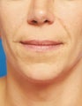 Lip Augmentation with Fat