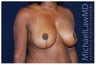 Breast Lift