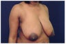 Breast Lift