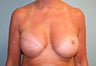 Female patient who underwent breast reconstruction