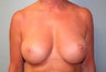 Female patient who underwent breast reconstruction