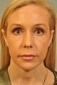 Chin Augmentation added to a surgery
