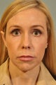 Chin Augmentation added to a surgery