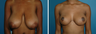 Breast Reduction
