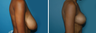 Breast Reduction