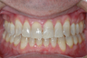 Irregular Alignment, Crossbite, and Midline Deviation Treated with Invisalign
