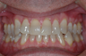 Irregular Alignment, Crossbite, and Midline Deviation Treated with Invisalign