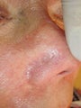 Before and After Veingogh Thermolysis for Spider Veins of the Face