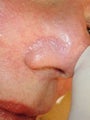Before and After Veingogh Thermolysis for Spider Veins of the Face