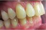Closing an extraction space with Invisalign
