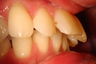 Closing an extraction space with Invisalign