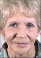 Rhinoplasty and Chemical Peel