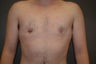 Keyhole approach with incision around areola to tighten and decrease areola size.