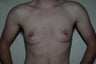 Keyhole approach with incision around areola to tighten and decrease areola size.