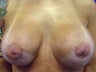 Female Patient Before & After Breast Lift