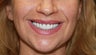 50 year old Patient treated with the All-on-4 Dental Implant Procedure