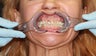 50 year old Patient treated with the All-on-4 Dental Implant Procedure