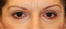 Eye Bag Surgery