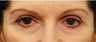 Eye Bag Surgery