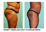 Smartlipo abdomen, hips & mons 3 mos post treatment -61 yr. old