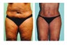 Smartlipo abdomen, hips & mons 3 mos post treatment -61 yr. old